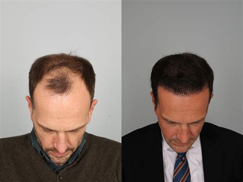 Neograft Hair Transplant Clinic .